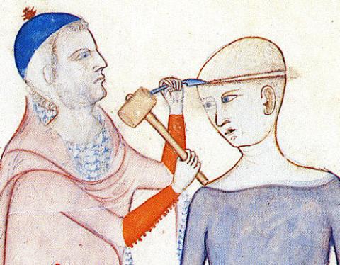 Middelalderens læger var længere fremme, end man lige går og tror. Selv komplicerede indgreb som "det hvide snit" mestrede de, som det fremgår af denne illustration fra 1400-tallet.