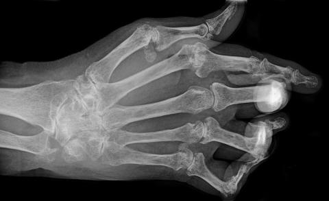 Hånd med ledødelæggelser pga. leddegigt. Nu udsættes behandlingen ikke længere, til leddene er nedbrudt.