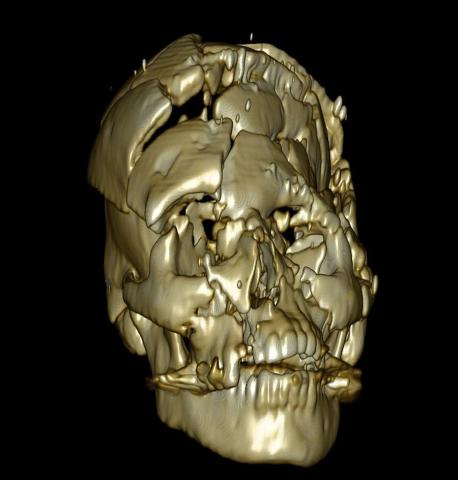 Knust kranium af trafikoffer. CT-skanningen viser, hvor knoglefragmenter og splinter har placeret sig ved påkørslen. Det formår en traditionel obduktion ikke. (Foto: Retsmediciksk Institut, SDU)