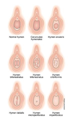 Hymen er en slimhinderand omkring skedeåbningen. Meget få har en hinde, der dækker fuldstændigt. Hymen er ofte halvmåneformet, men kan også være hullet og strengformet. Illustration: Birgitte Lerche-Barlach.