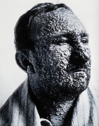 Koppepatient, ca. 1900. The Wellcome Collection.