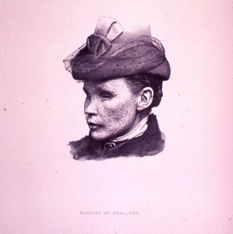 Overlevende efter koppeangreb kunne være dækket af vansirende ar. Foto fra slutningen af 1800-tallet. Foto: National Library of Medicine.