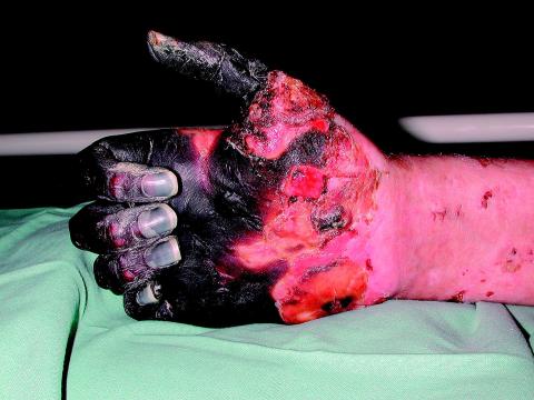 koldbrand, hænder, 280878-1290, mette liebst-olsen