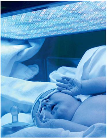 Nyfødt barn med svær gulsot får lysbehandling.
