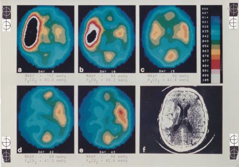Tomografisk snit der viser det regionale blodflow i hjernen hos en patient med en stor læsion i højre hemisfære. I læsionen ses nedsat centralt blodflow med hyperæmi i randzonen. Dette svinder ved gentagne undersøgelser over de næste 47 dage. Undersøgelsen er udført i 1985 med tomografen Tomomatic-64 og inhalation af xenon-133 (Fra Niels A. Lassens lysbilledsamling).