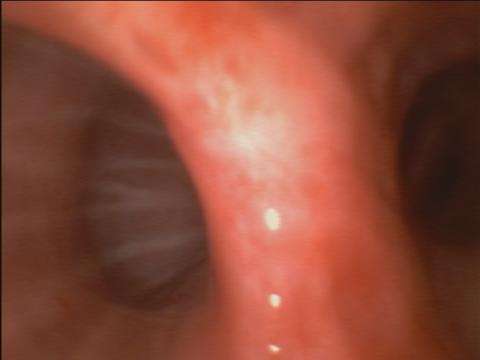 Bronchoscopic recording of a coronavirus disease 2019 patient.