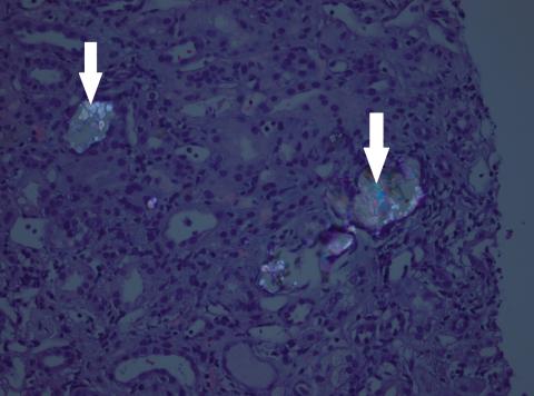 Der ses dobbeltbrydende calciumoxalatkrystaller (pile) i ­tubuli ved polariserende lys. Hæmatoxylin-eosin-farvning. For­størrelse 20 ×.