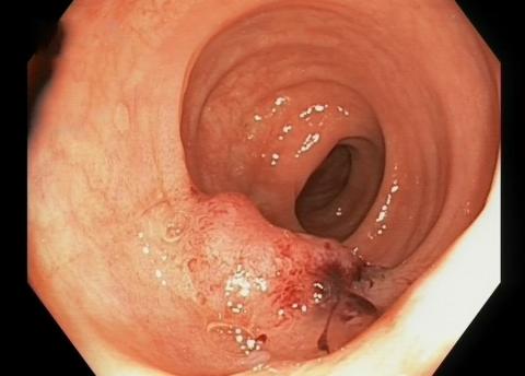 Adenokarcinom på 1,5 cm i diameter i sigmoideum hos en ­84-årig mand.