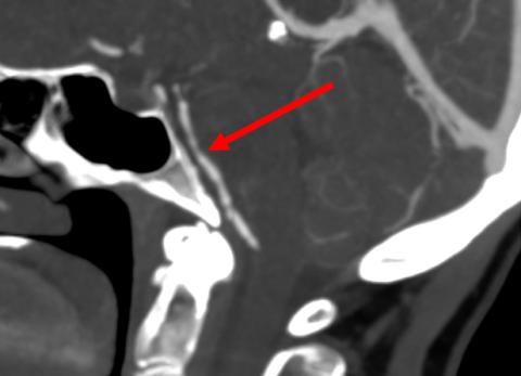 Sagittalt snit af arteria basilaris med karspasmer (pil). Tegnet kaldes »perler på en snor« og er klassisk for reversibelt cerebralt vasokonstriktionssyndrom.