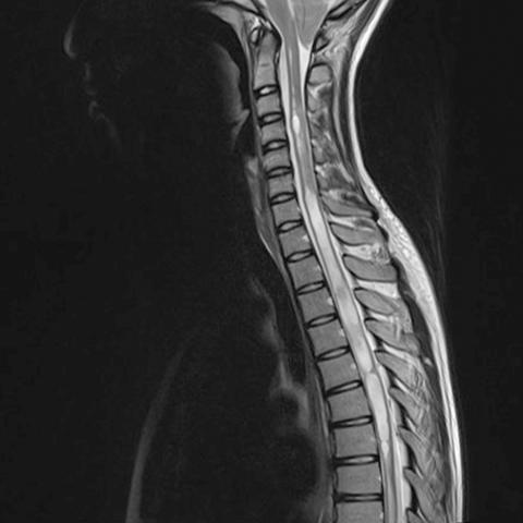 T2-vægtet MR-skanningsbillede af en patient med Arnold Chiari-­malformation og syringomyeli.