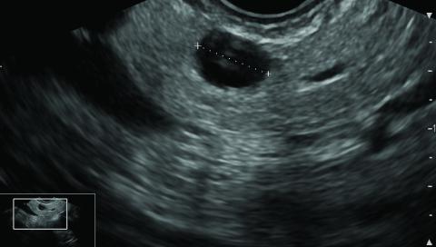 Endoscopic ultrasound showing a suspected 7-mm branch duct intraductal papillary mucinous neoplasm of the pancreas.