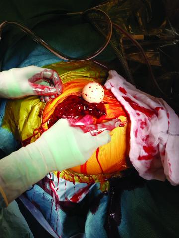 Den lukserede liner, der kom til syne i operationsfeltet med koaguleret blod efter gennembrydning af fascien.