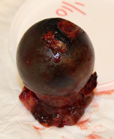 Sort caput femoris fjernet under hoftealloplastik. Læg mærke til bruskdefekten.