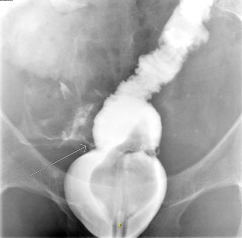 A small leak (arrow) from the colorectal anastomosis following low anterior resection.