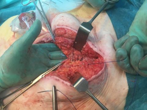 Mass closure-teknik ved operation for fascieruptur.