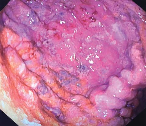 Regastroskopi foretaget 18-19 timer efter indtag af jerntabletter. Der ses punktvise slimhindenekroser og rester af jerntabletter i ventriklen.