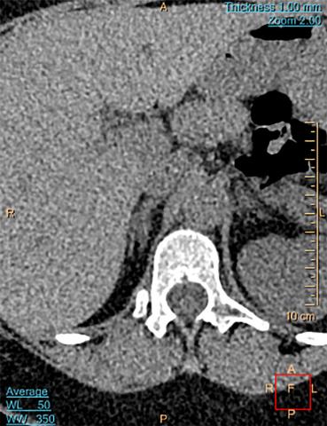 Højresidig godartet binyretumor, homogen, velafgrænset, Hounsfieldenheder < 10, størrelse > 1 cm på den korteste akse. 