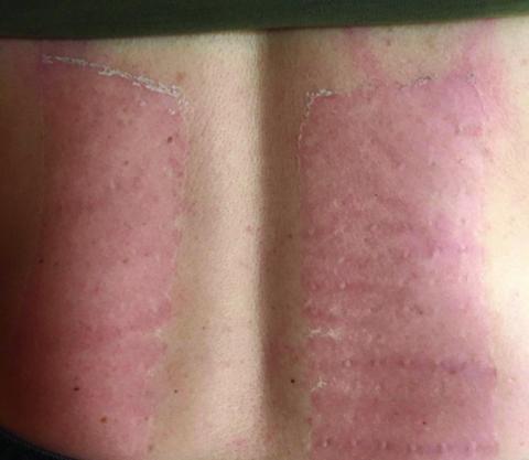 Rødme og ødem af huden efter fjernelse af chiliplastre. Billedet bringes med patientens tilladelse.