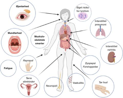 Manifestationer ved Sjögrens syndrom. Created with BioRender.com