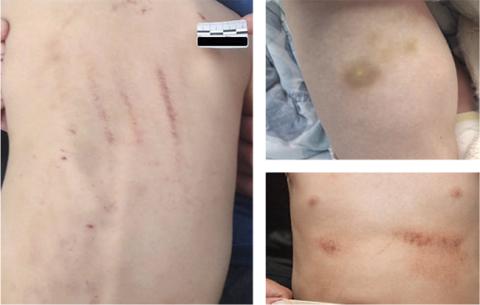 Omkring hvert sjette barn i Danmark er udsat for fysiske overgreb.