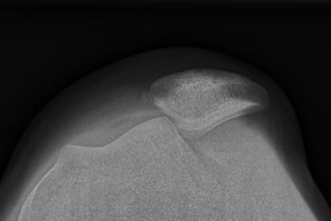 Tangentialoptagelse af et knæ med lateral patellaluksation.