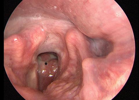 Øvre luftveje med obstruerende forandring (markeret med *).