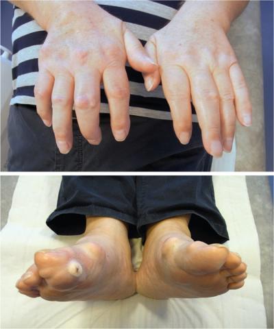 A 60-year-old male with abundant urate deposits (tophi) after 20 years with undiagnosed gout and no urate-lowering therapy. 