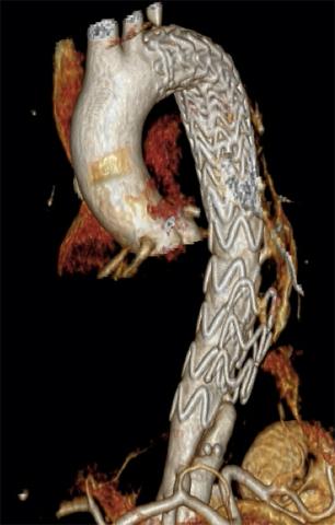 CT-rekonstruktion af aorta med type B-dissektion behandlet med thoracic endovascular aortic repair (TEVAR) fra afgangen af a. subclavia sinister til kranielt for truncus coeliacus.