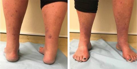 Foddeformitet ved Charcot-Marie-Tooths sygdom.