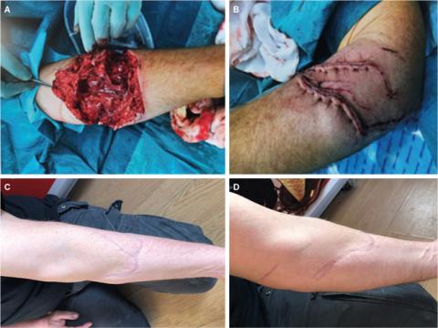 A. Sår ved primær eksploration. B. Endelig lukning efter flere revisioner. C + D. Kosmetisk resultat efter 8 mdr.