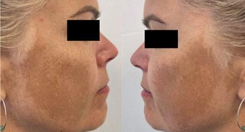 Klassisk udbredelse af melasma med symmetrisk udbredelse af makulær hyperpigmentering på kinderne.