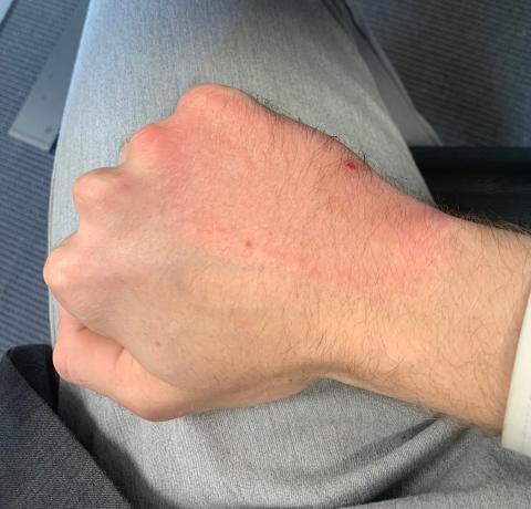 Erythema migrans. Billedet er gengivet med patientens tilladelse.