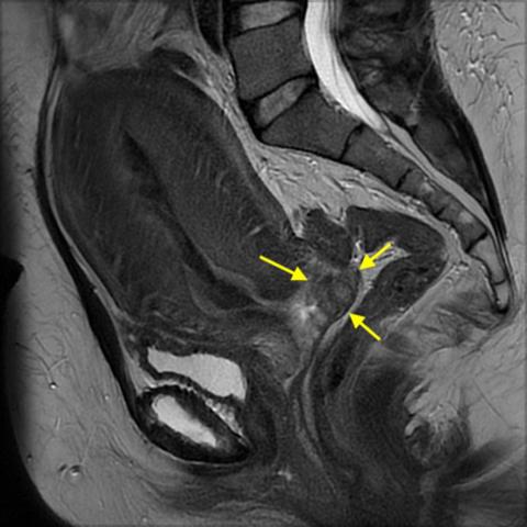 MR-skanningsbillede, der viser tumor i forreste portiolæbe (gule pile). Gengivet med patientens tilladelse.